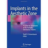 Implants in the Aesthetic Zone: A Guide for Treatment of the Partially Edentulous Patient